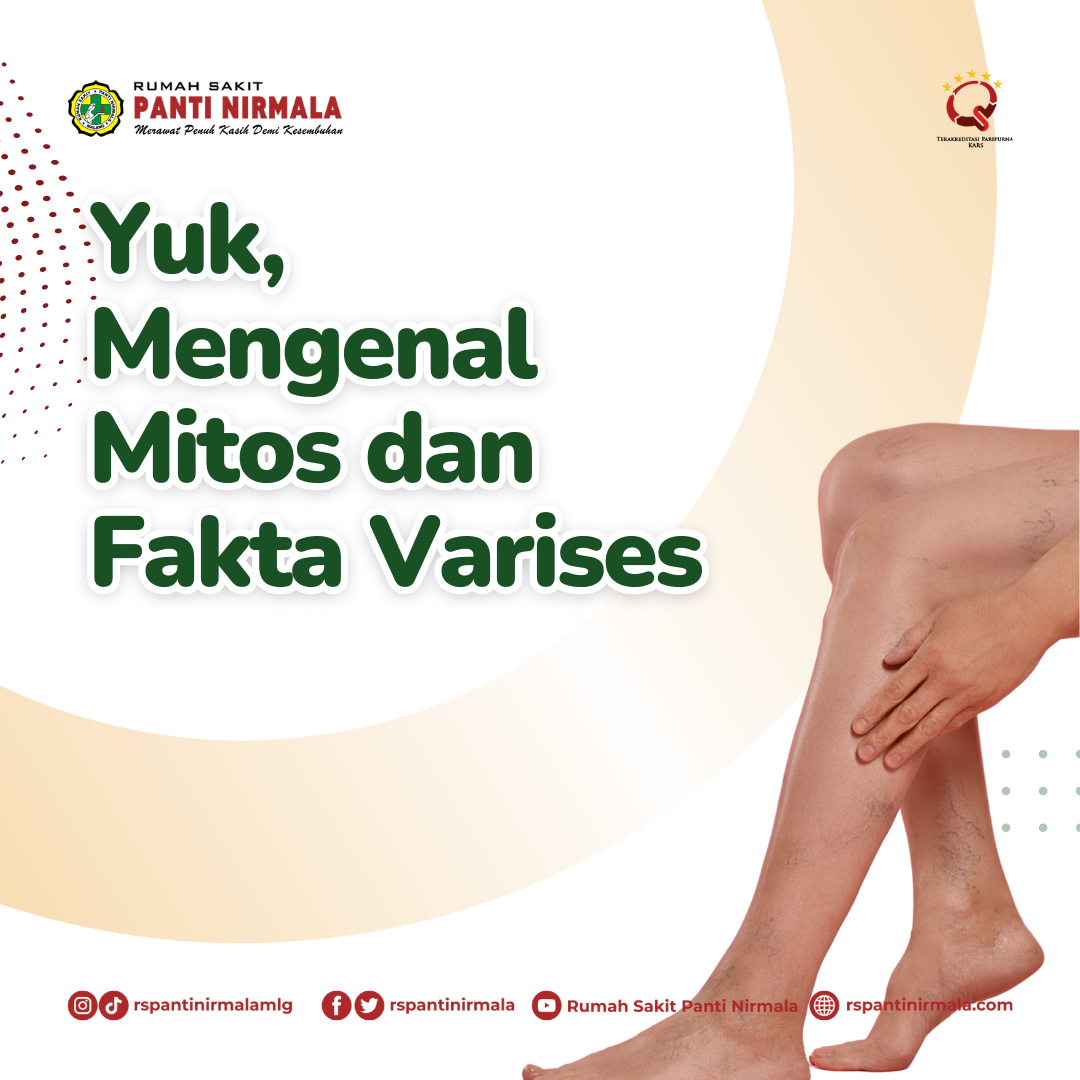 Mitos dan Fakta Seputar Varises