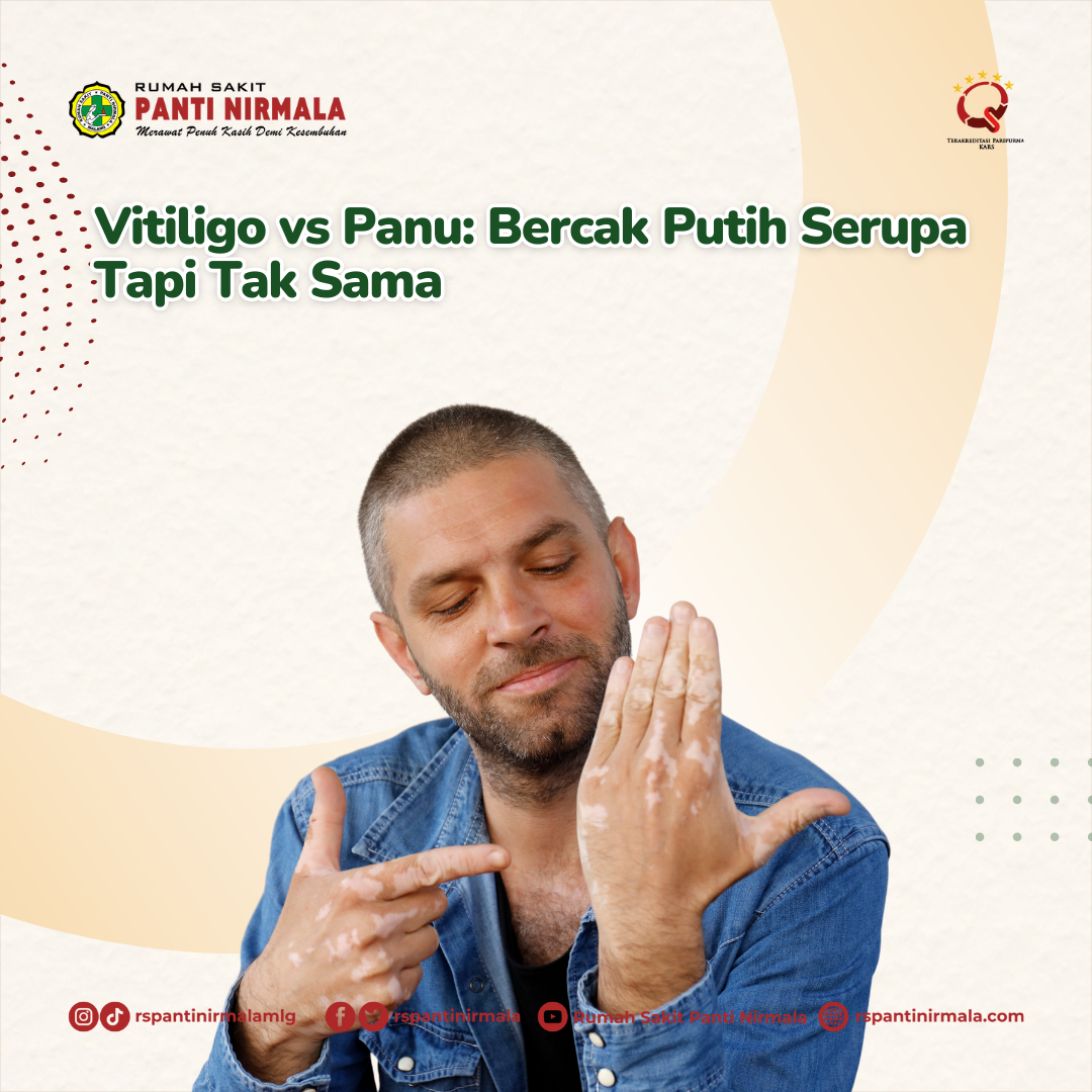 Vitiligo vs Panu: Bercak Putih Serupa Tapi Tak Sama