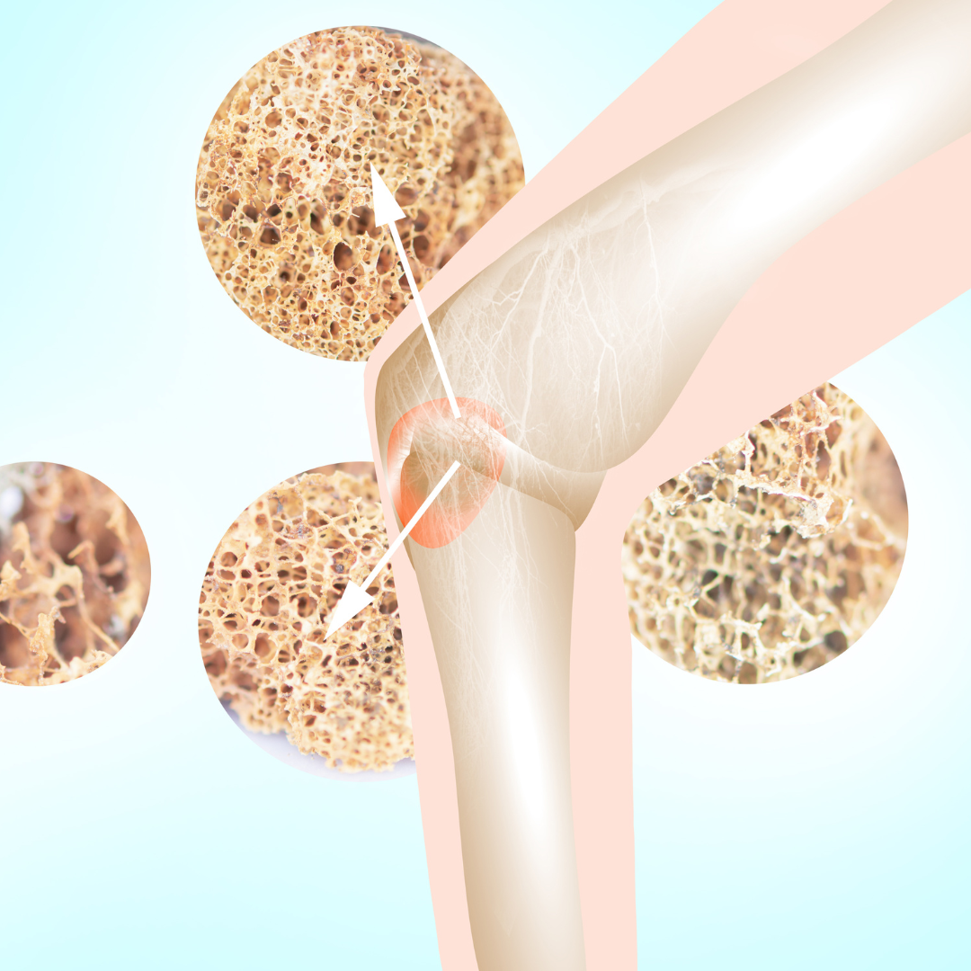 Pengenalan Osteoporosis